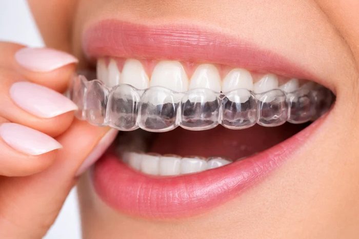 Clear aligner on teeth