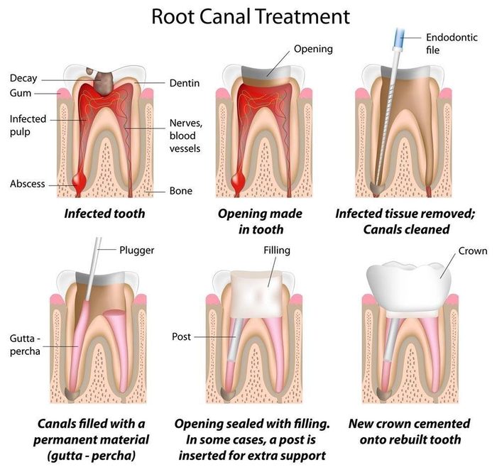 Root canal treatment diagram