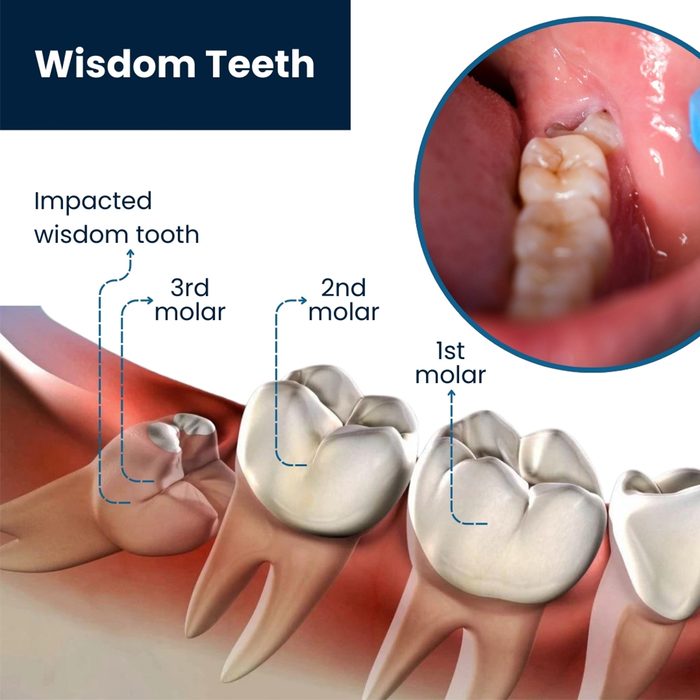Wisdom tooth diagram