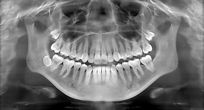 Dental X-ray scan